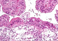 【Science速递】“寡言的杀手”卵巢癌的医治新靶点终于被发现了